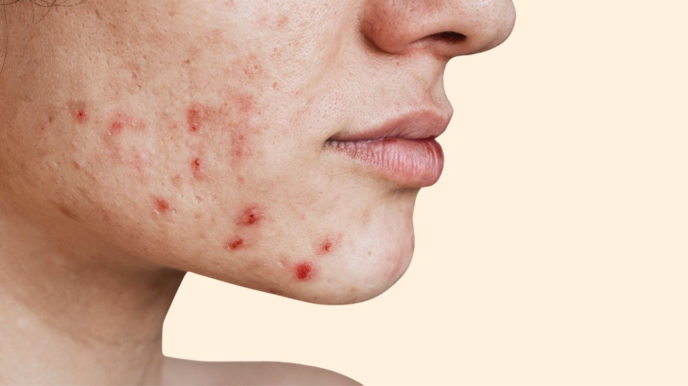acne skin