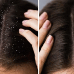 anti fungal shampoo