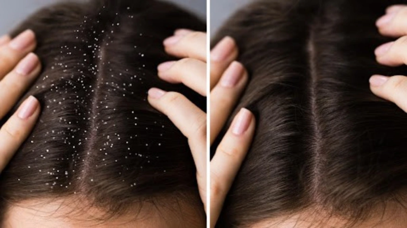 anti fungal shampoo